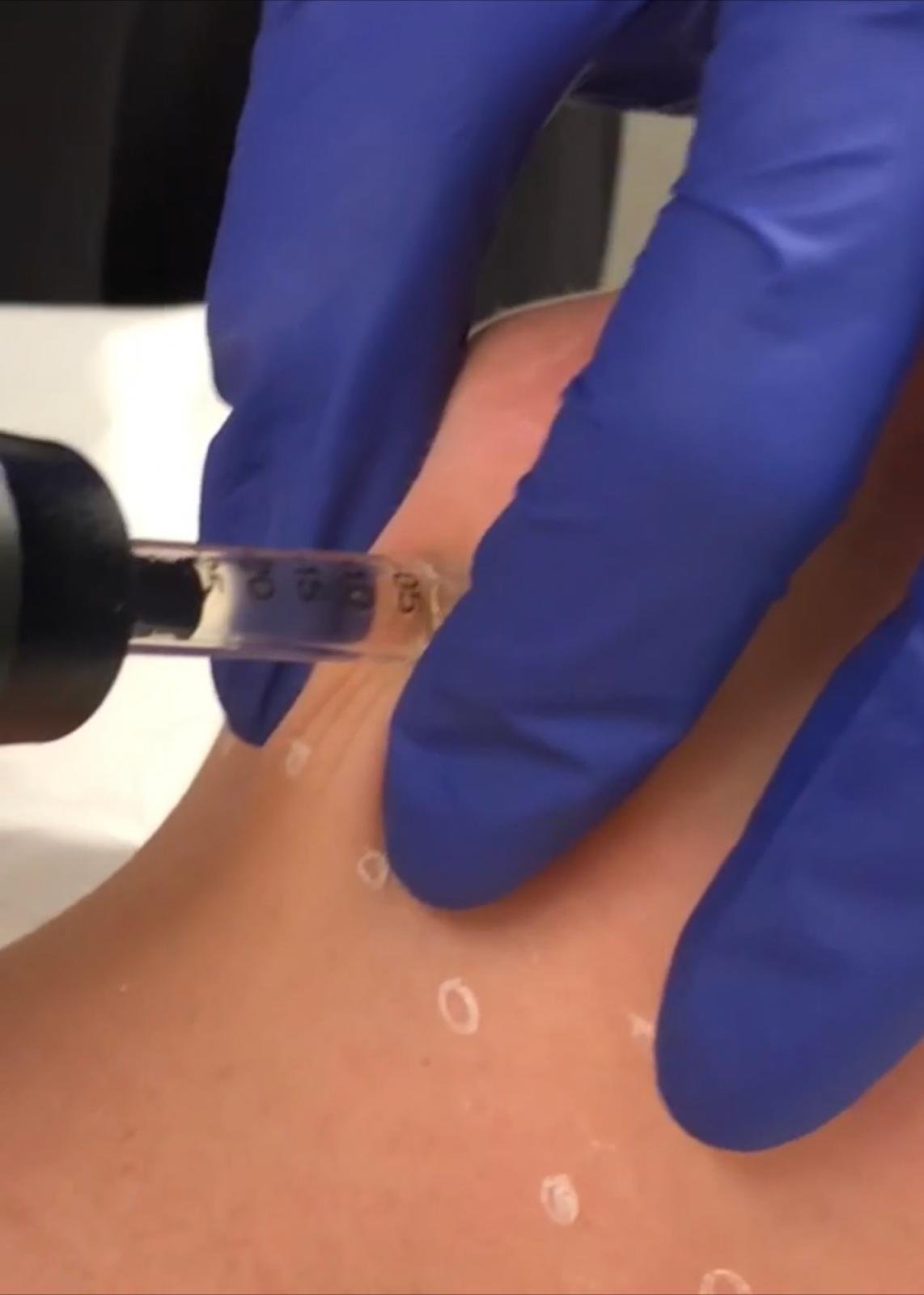 Mesoterapia Reduccion Papada