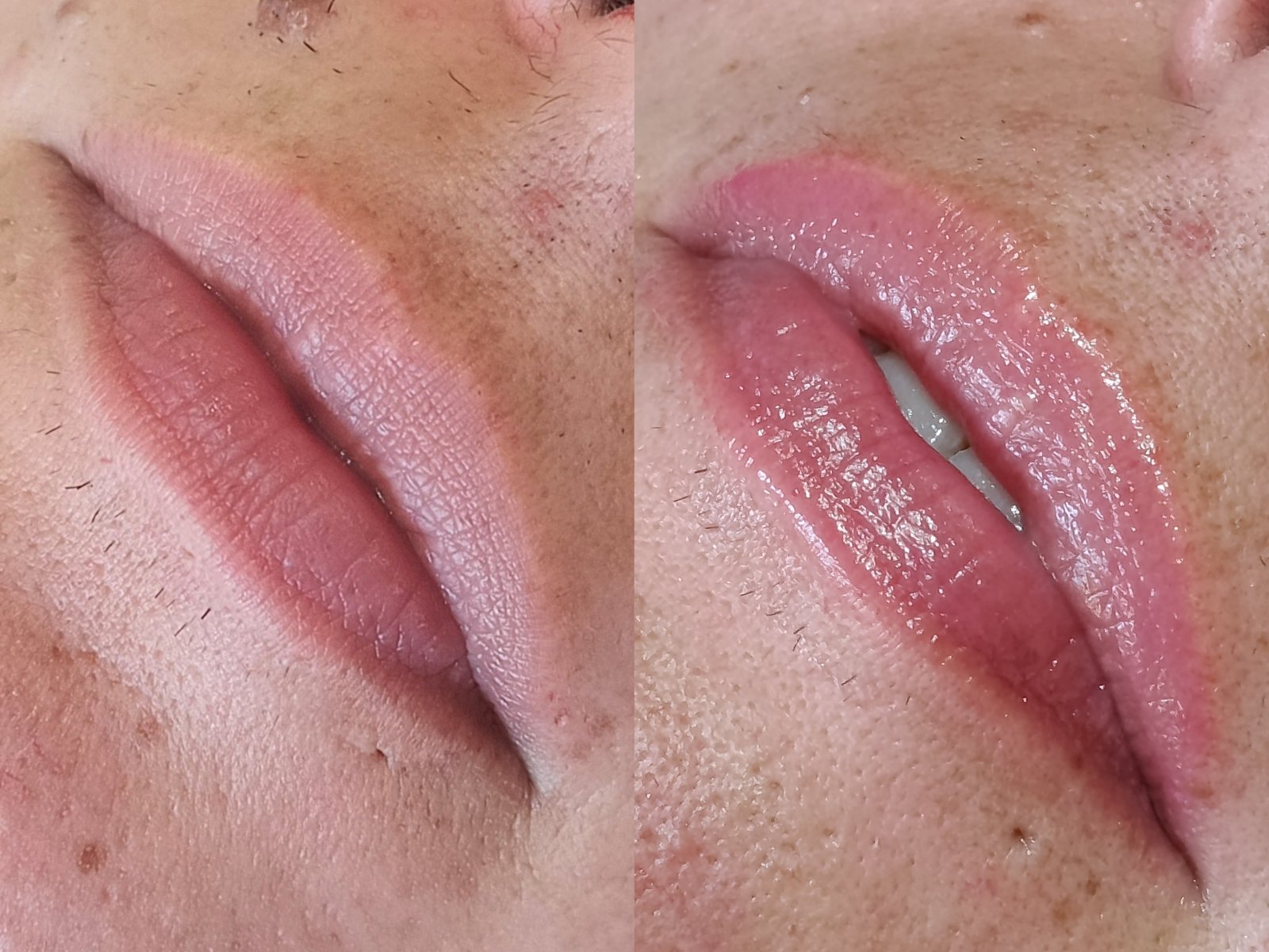 Revitalizacion Labial Antes y Despues